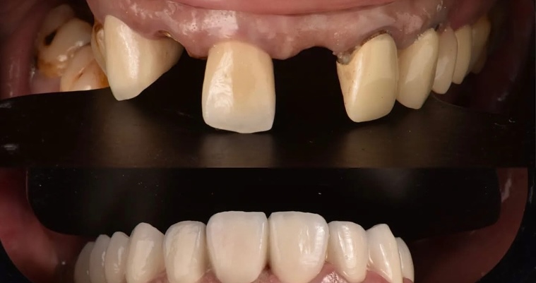 Nouveau sourire, nouvelle vie - Transformation 4